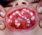 Hampaiden poikkeavuudet