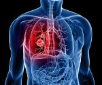 Keuhkosyövän uusiutuminen