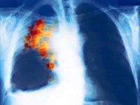 Pienisoluinen keuhkosyöpä