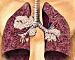Pienisoluinen keuhkosyöpä