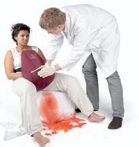 Synnytyksen jälkeinen verenvuoto
