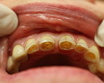 Hampaiden epänormaali kuluminen