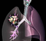 Pahanlaatuiset keuhkosyöpät