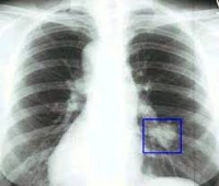 Pahanlaatuiset keuhkosyöpät
