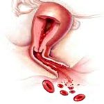 Synnytyksen jälkeinen verenvuoto
