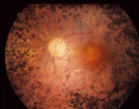 Pigmentoitunut retiniitti
