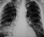 Bronchioloalveolaarinen syöpä (alveolaarinen syöpäsyöpä, bronchoalveolaarinen syöpä, pseudo-keuhkokuume)
