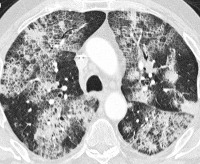 Bronchioloalveolaarinen syöpä (alveolaarinen syöpäsyöpä, bronchoalveolaarinen syöpä, pseudo-keuhkokuume)