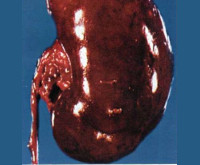 Tukkoinen munuainen (nefrogeeninen laskimohyperemia, sydämen munuaiset, krooninen kardiorenalioireyhtymä)