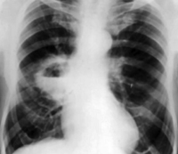 Keuhkojen ja keuhkojen vieraskappaleet